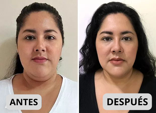 Súper Mascara Reductor De Papada